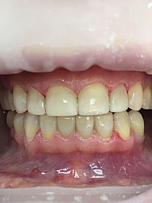 Реставрация зубов