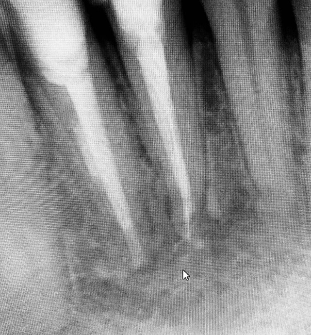 Лечение гранулематозного периодонтита