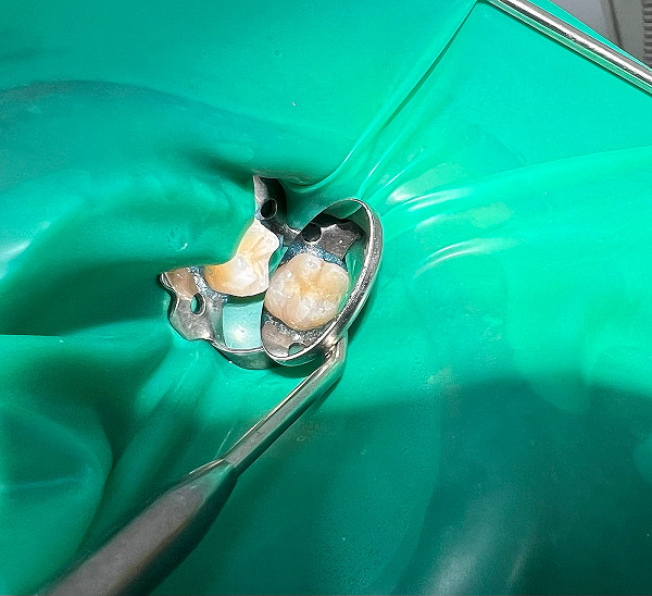 Лечение кариеса