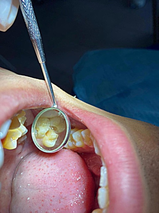 Лечение кариеса