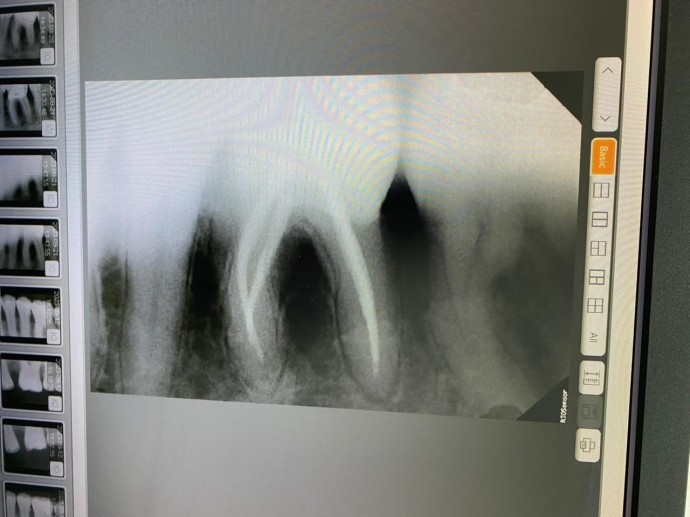 Лечение каналов