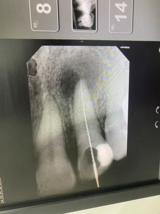 Лечение каналов
