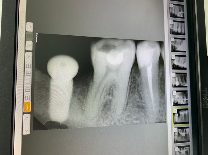 Лечение каналов