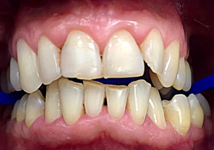 Реставрация зубов