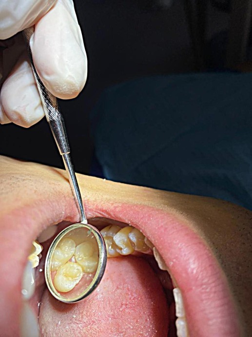 Лечение кариеса