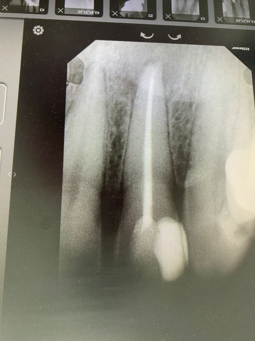 Лечение каналов