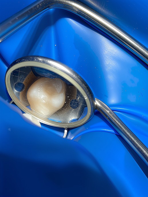 Лечение кариеса