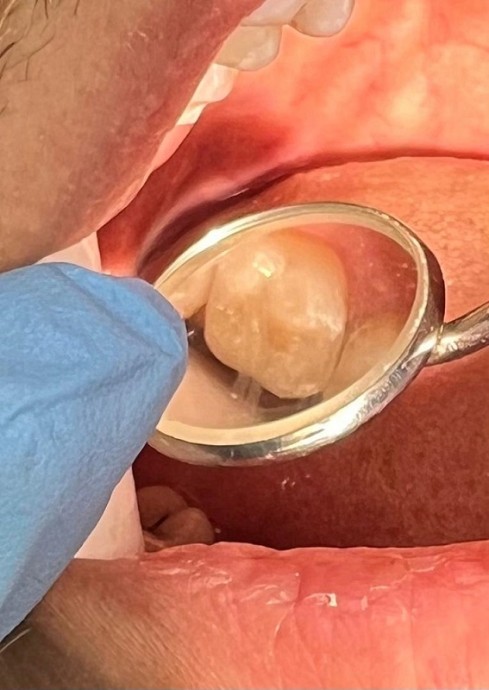 Лечение кариеса