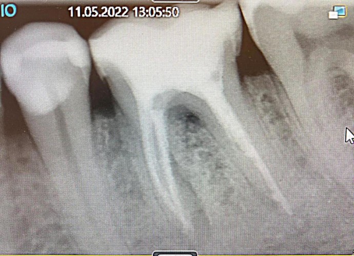 Лечение гранулематозного периодонтита