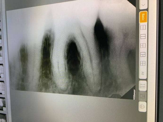 Лечение каналов