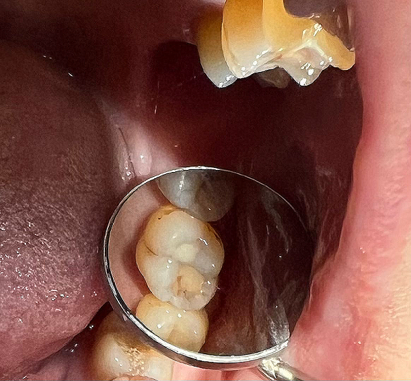 Лечение кариеса