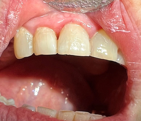 Реставрация зубов