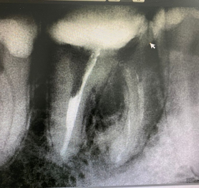 Лечение каналов