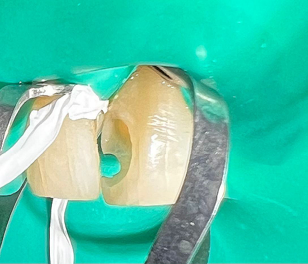 Реставрация зубов