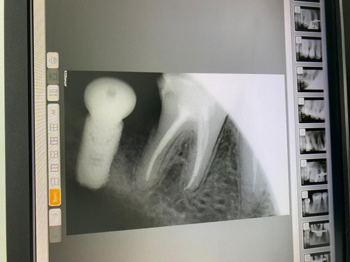 Лечение каналов