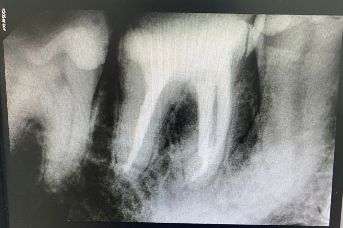 Лечение каналов