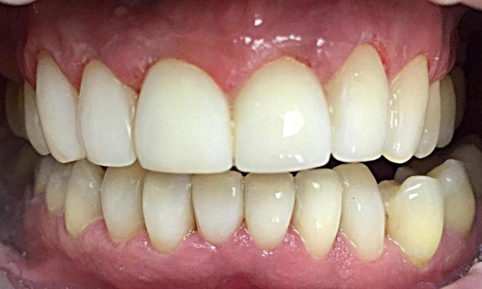 Реставрация зубов