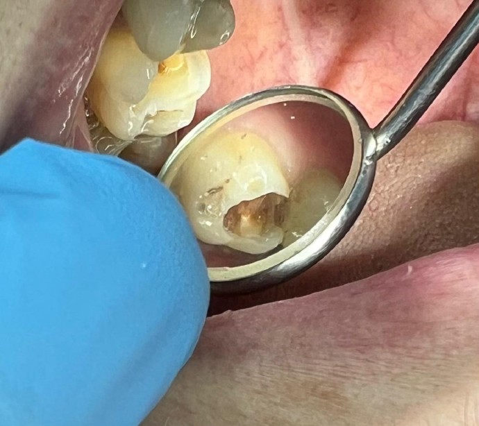 Лечение кариеса