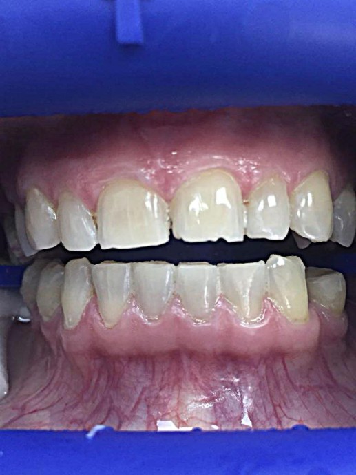 Реставрация зубов